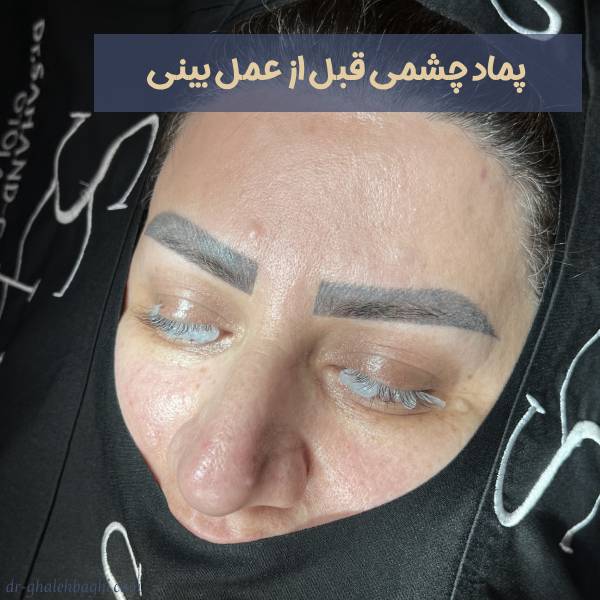 پماد چشم قبل از عمل بینی
