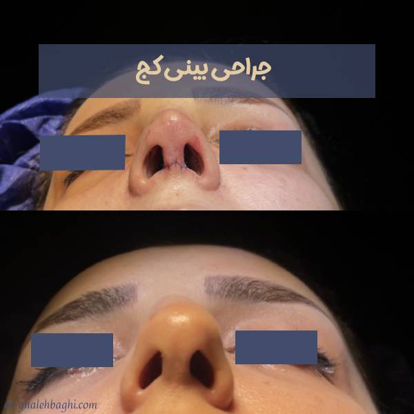 عکس نمونه عمل بینی کج
