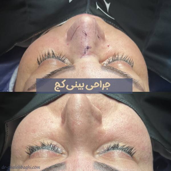عکس جراحی بینی کج