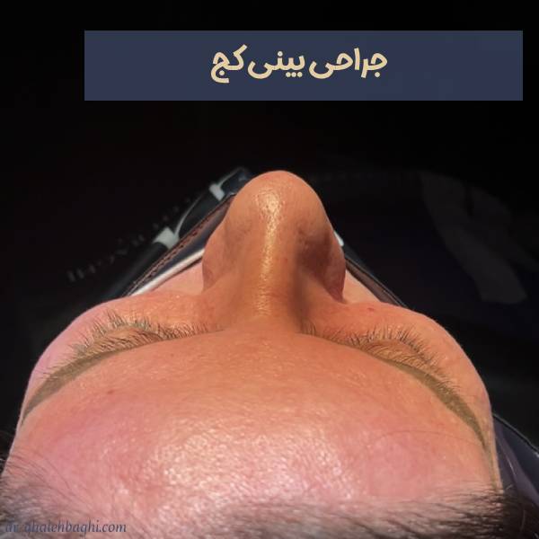 عکس جراحی بینی کج