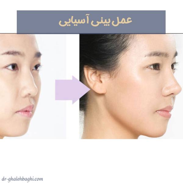 عکس بینی آسیایی