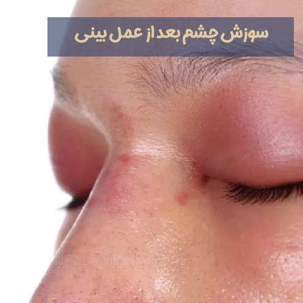 سوزش چشم بعد از عمل بینی