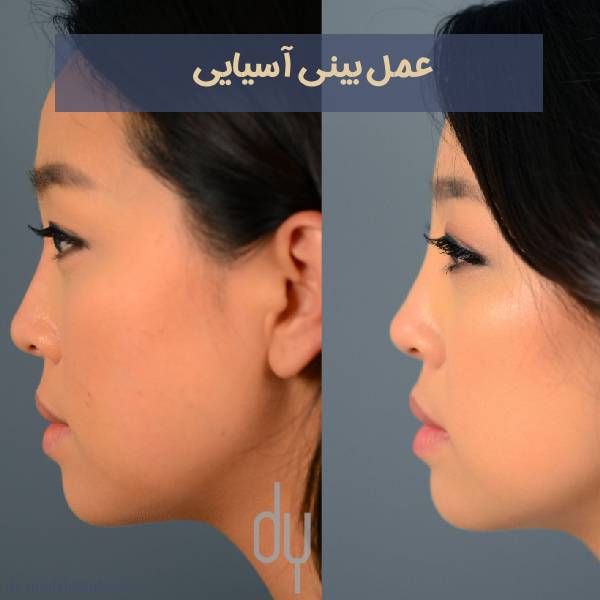 جراحی بینی آسیایی