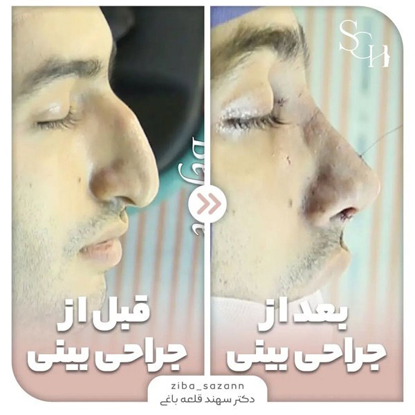 عکس قبل و بعد از جراحی بینی استخوانی قوزدار