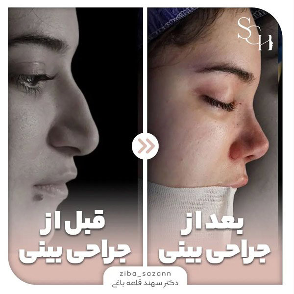 عکس قبل و بعد از جراحی بینی استخوانی قوزدار
