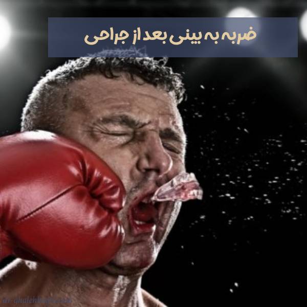 ضربه خوردن به بینی بعد از عمل