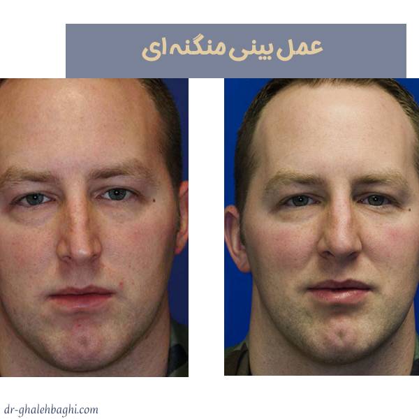 عمل بینی منگنه ای