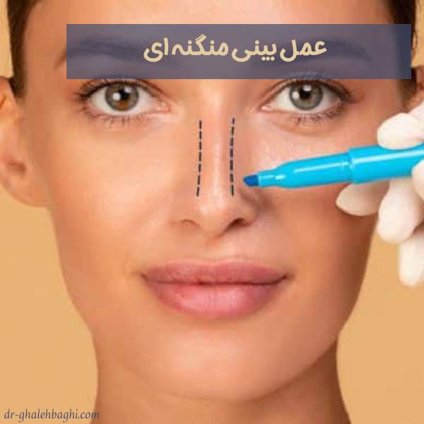 جراحی بینی منگنه ای