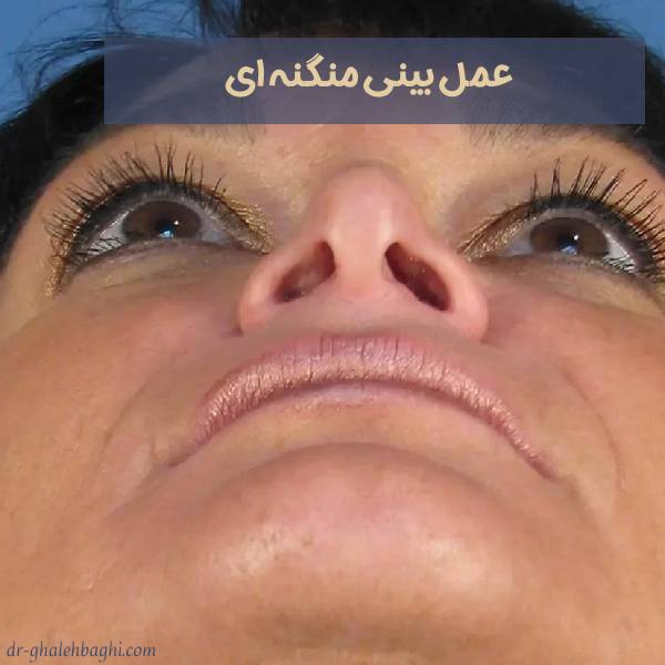 جراحی بینی منگنه ای