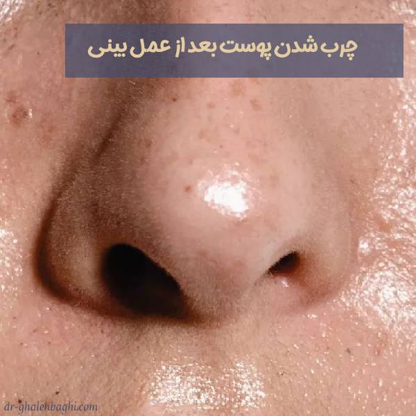 چرب شدن پوست بعد از جراحی بینی
