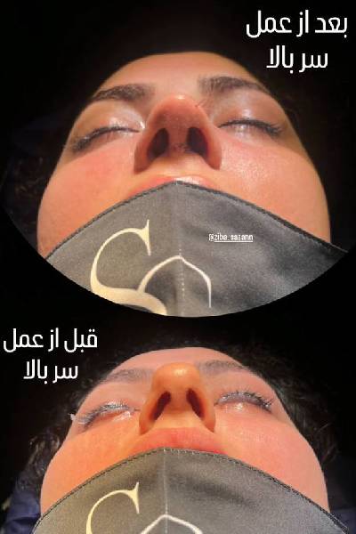 نمونه کارهای بهترین جراح بینی تهران
