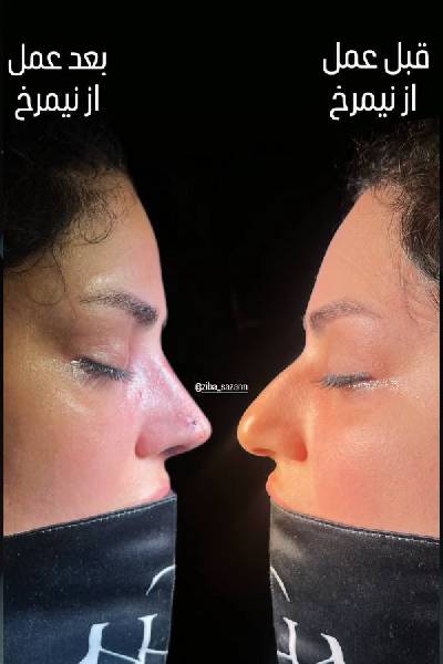 نمونه کارهای بهترین جراح بینی تهران