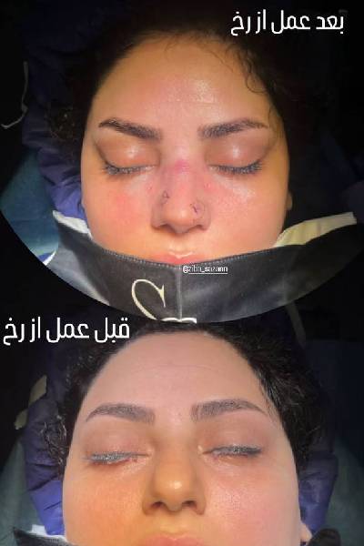 نمونه کارهای بهترین جراح بینی تهران