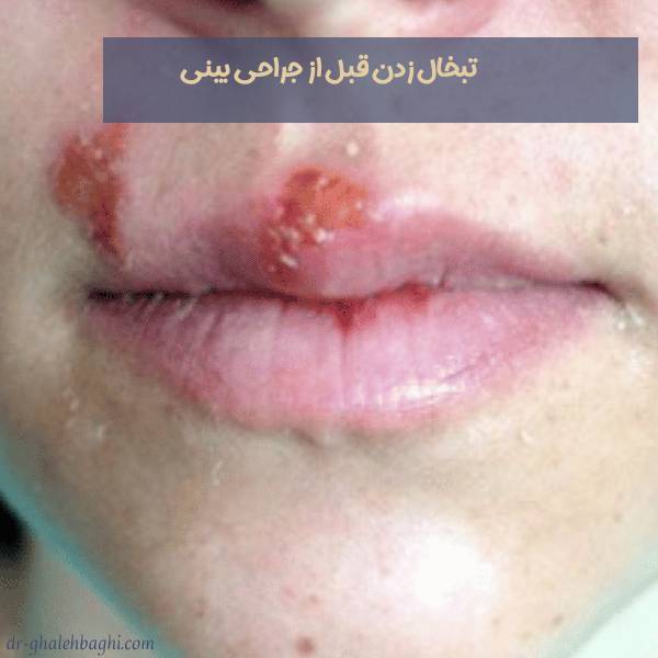 تبخال قبل از عمل بینی