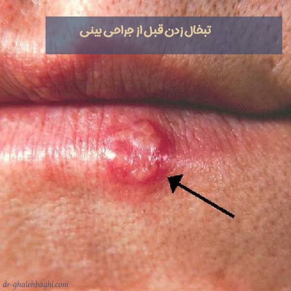 تبخال زدن قبل از جراحی بنیی