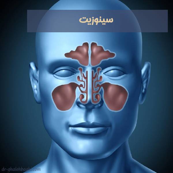 عکس سینوزیت