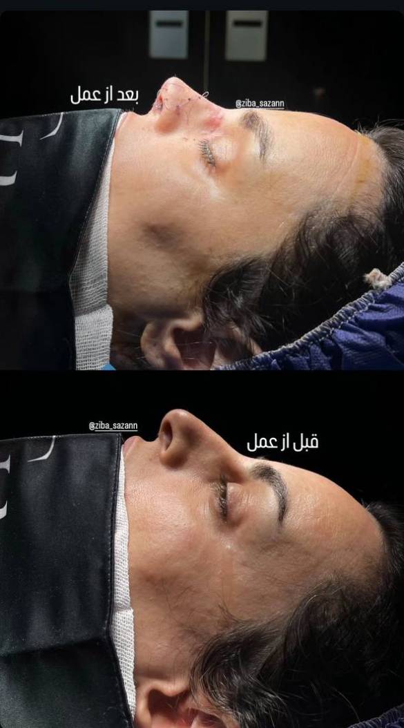 نمونه کارهای بهترین دکتر عمل بینی تهران