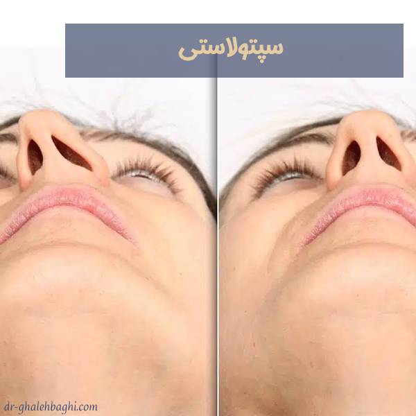 سپتوپلاستی