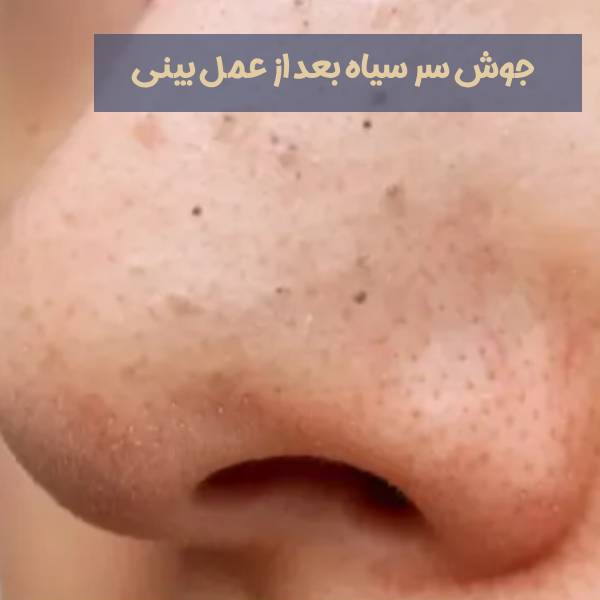 جوش سر سیاه بعد از عمل بینی