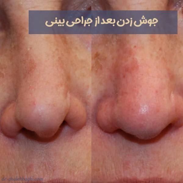 جوش زدن بعد از عمل بینی
