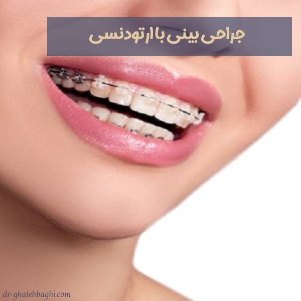 عمل بینی با وجود ارتودنسی