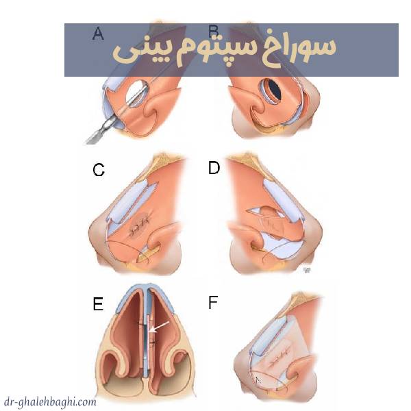 سوراخ سپتوم بینی