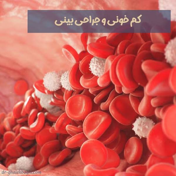 کم خونی برای عمل بینی
