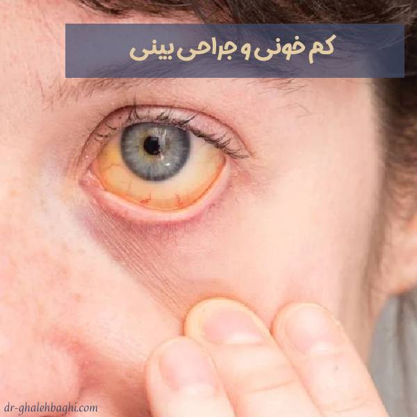 کم خونی و جراحی بینی