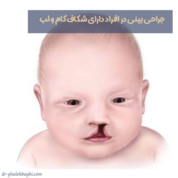 جراحی بینی در افراد دارای شکاف کام و لب