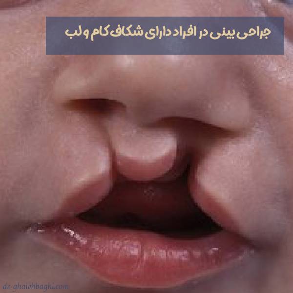 جراحی بینی در افراد دارای شکاف کام و لب