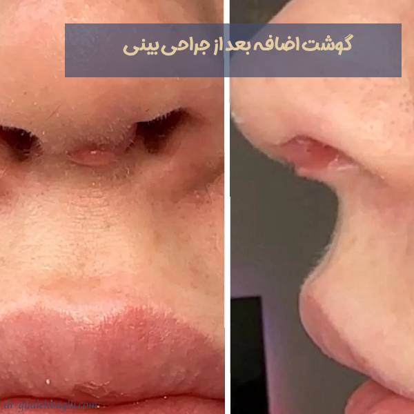گوشت اضافه بعد از جراحی بینی