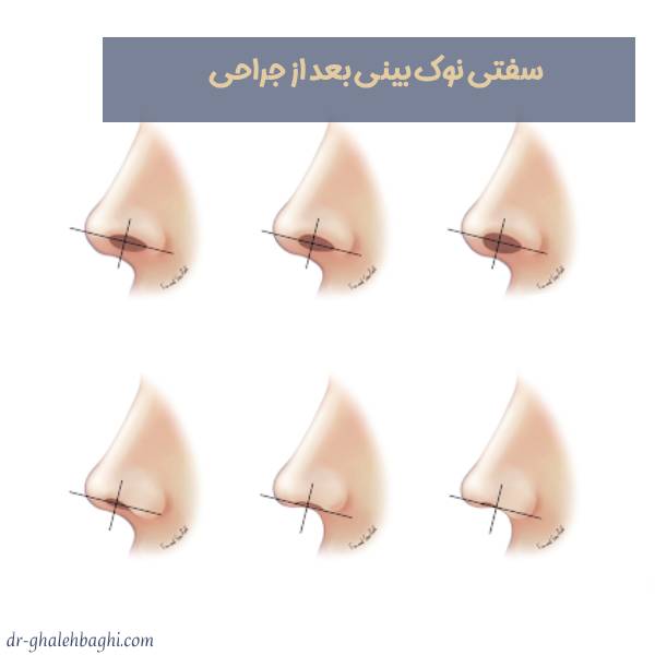 سفتی نوک بینی بعد از جراحی
