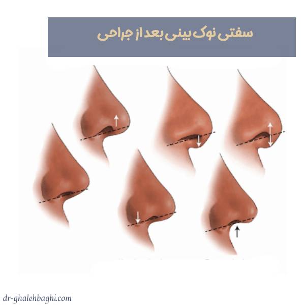 سفتی نوک بینی بعد از جراحی